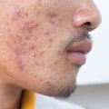 Acne Treatments for Men: The Ultimate Guide