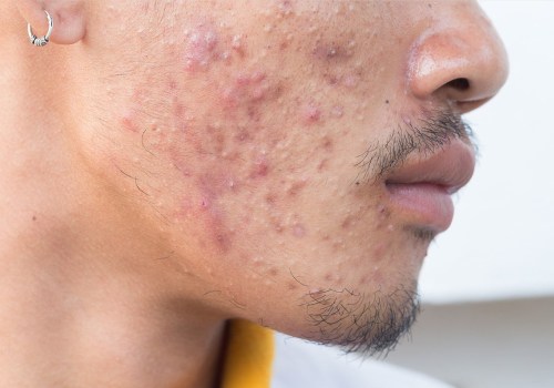 Acne Treatments for Men: The Ultimate Guide